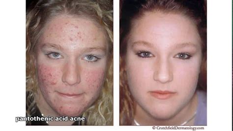 The management of minor skin disorders. pantothenic acid acne - YouTube