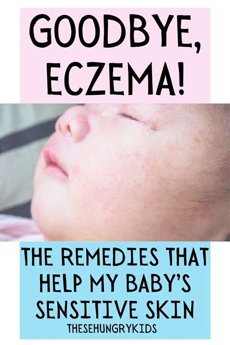Aliya Diys Diy Eczema Treatment For Babies