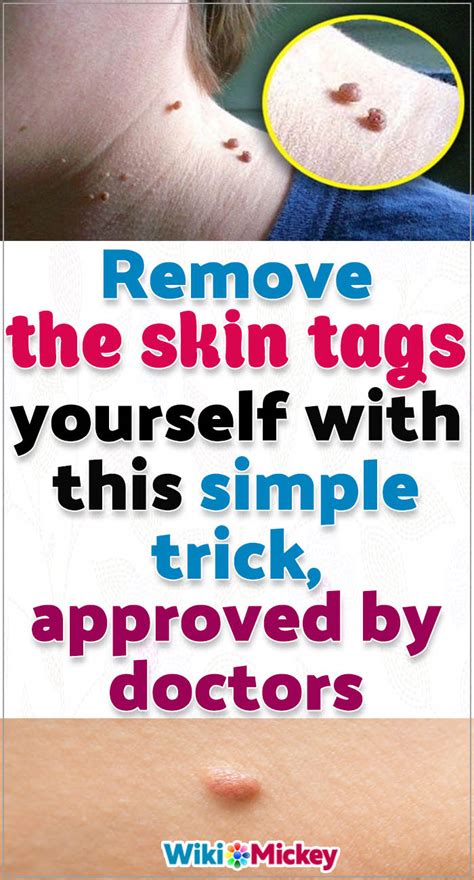 home remedies to remove skin tags with apple cider vinegar social useful stuff handy tips