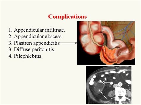 Acute Appendicitis Koray Topgl Md Prof Department Of