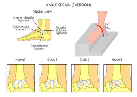 Sprained Ankle Learn How To Treat A Sprained Ankle