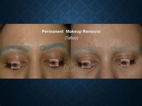 Pin By Moawad Skin Institute On Tattoo Laser Removal