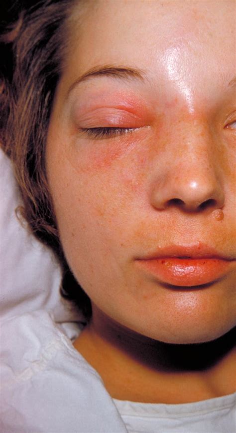 Orbital Cellulitis Physician Assistant Exam Review