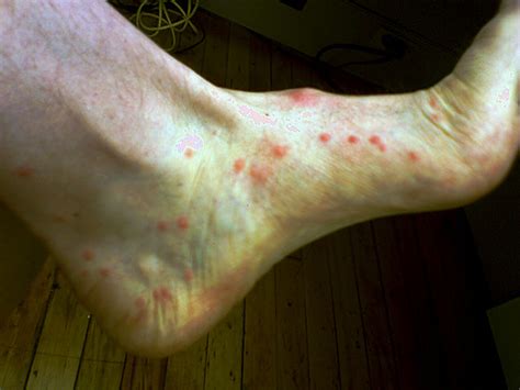 Flea Bites On Humans Pictures Symptoms And Treatment