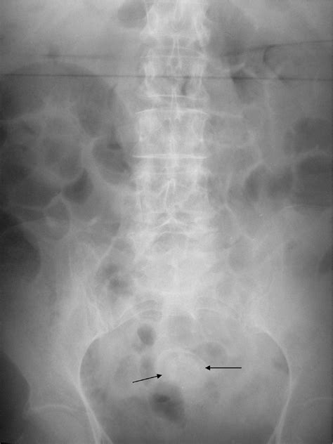 Figure 1 From Large Bowel Obstruction Secondary To Gallstone Impaction