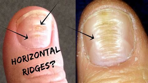 Horizontal Ridges And Beaus Lines On Your Nails Palmistry
