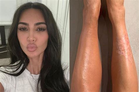 kim kardashian said she s given up on her chronic psoriasis here s how 3 women manage theirs