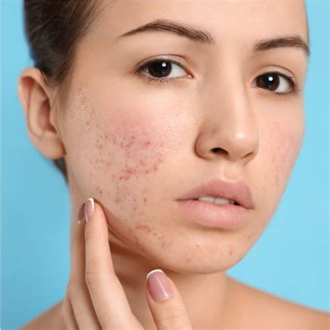 Acne Scar Subcision Benefits Of Subscision For Scars