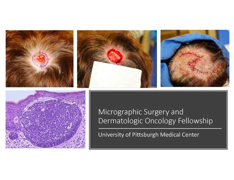Mohs Micrographic And Dermatology Oncology Fellowship Department Of