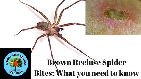 Brown Recluse Spider Bites What You Need To Know Youtube