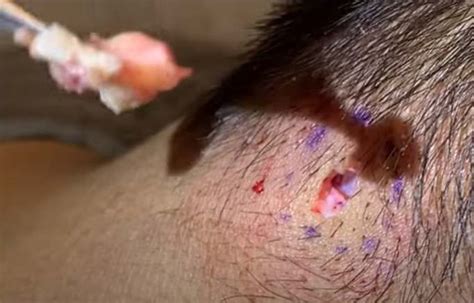 Infected Sebaceous Cyst Excision New Pimple Popping Videos
