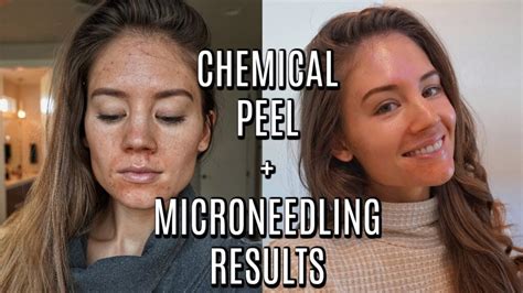 Microneedling Vs Chemical Peel Which Is Better For Your Skin Healthy