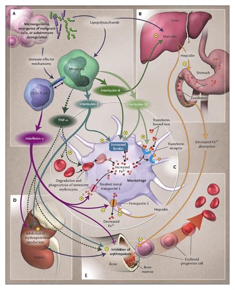 The exact cause of anemia of chronic disease may vary. Anemia of Chronic Disease | NEJM