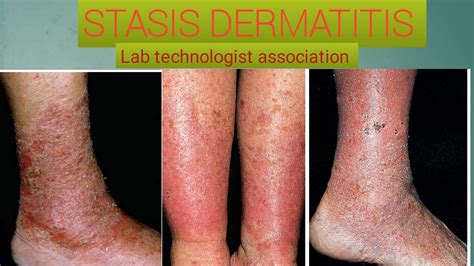 Treatment Of Stasis Dermatitis Youtube