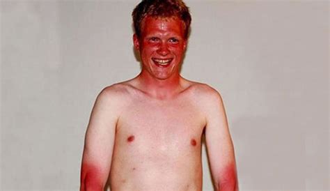 Oc Man Suffers Incredibly Severe Sunburn After Waiting Hours For