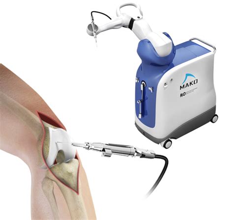 Robotic Assisted Knee Surgery Cincinnati Oh Makoplasty Kentucky Ohio