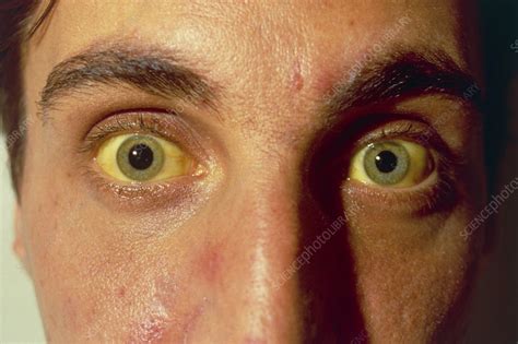 Face And Eyes Of Patient Suffering Jaundice Stock Image M1900065