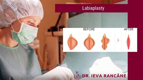 Intimate Plastic Surgery Labiaplasty Youtube