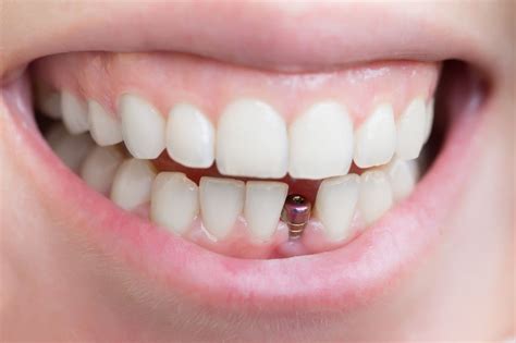 What Happens To Real Teeth Under Veneers Teethwalls