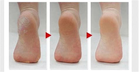 To remove dead skin feet, soak your feet with warm water. 10 Ways To Get Rid Of Dead Skin On Feet | HowHunter