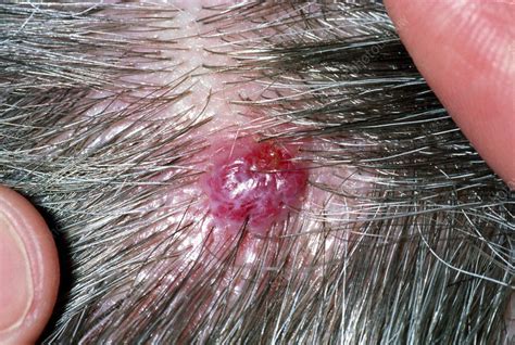 Haemangioma On The Scalp Stock Image M1700188 Science Photo Library