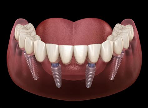 The History Of All On Dental Implants Advanced Family Dentistry Tucson Arizona