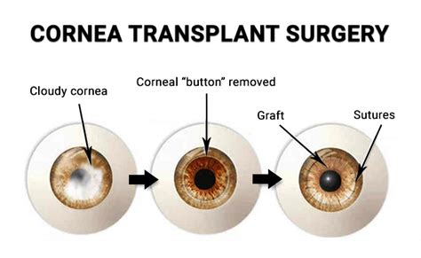 Cornea Transplant Nyc Vitreous Retina Macula Consultants Of New York