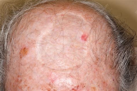 Basal Cell Carcinoma On Scalp Core Plastic Surgery