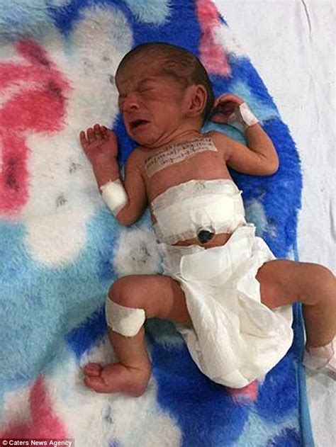 Indian Baby Born With An Additional Head Attached To Its Stomach