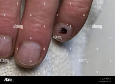 Finger Nail Blood Blister Subungual Hematoma Close Up On Elderly Mans