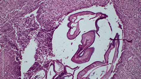 Parasitic Flatworms In Humans Cross Sections Of Dirofilaria Spp From