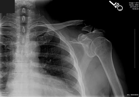 Clavicle Shaft Fractures Trauma Orthobullets