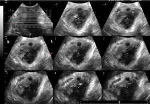 Tomographic Ultrasound Imaging Tui Imaging Of The Levator Hiatus With
