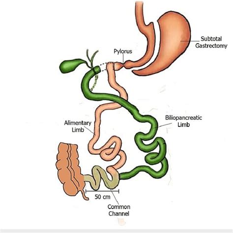 The Duodenal Switch Procedure Based On A Figure Published By Anthone
