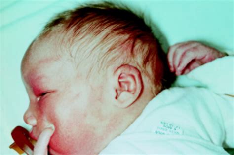 Albinism Modern Molecular Diagnosis British Journal Of Ophthalmology