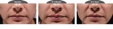 Bellafill A Safe And Effective Dermal Filler For Men Who Want To