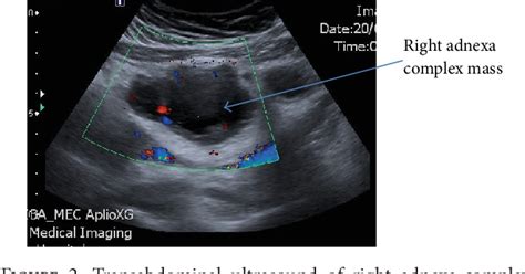 figure 2 from tuboovarian abscess as primary presentation for imperforate hymen semantic scholar