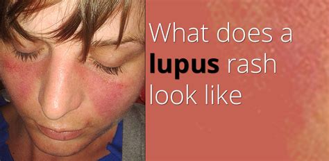 What Does A Lupus Rash Look Like