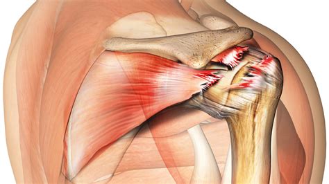 Effectiveness Of Exercise In Rotator Cuff Related Shoulder Pain The