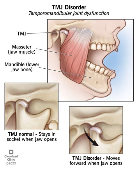 Tmj Disorders Symptoms Causes And Treatment