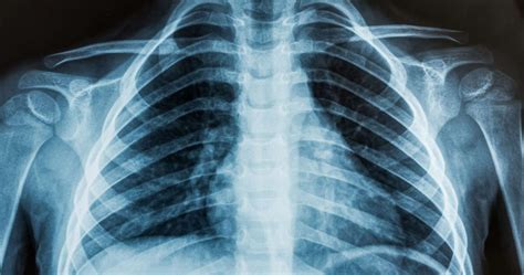 Odma Płucna Odma Opłucnowa Przyczyny Objawy Leczenie Powikłania