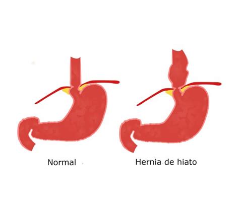 Patolog As Que Provocan Hernia De Hiato Viamed Salud