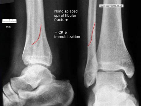 Ppt X Ray Rounds Plain Radiographic Evaluation Of The Ankle