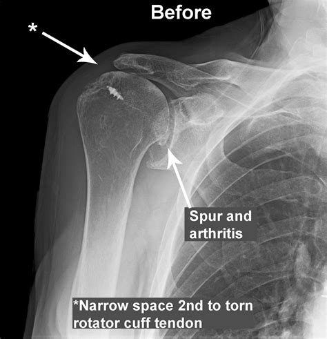 Shoulder Injuries X Rays Of Shoulder Injuries