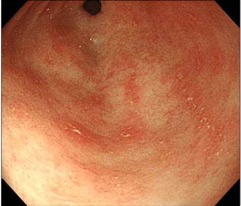 Upper Gastrointestinal Endoscopic Finding It Showed Multiple Linear