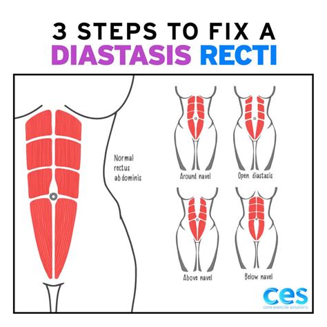 3 Steps To Fix A Diastasis Recti Core Exercise Solutions Diastasis