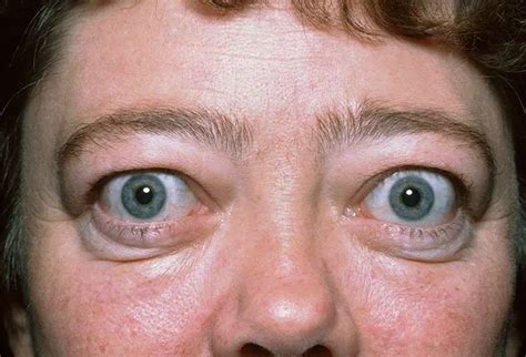 Is Graves Disease Fatal Eye Symptoms Treatment Diagnosis And Diet