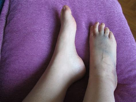 Sprained Ankle After 18 Days Sandymillin Eltpics Flickr