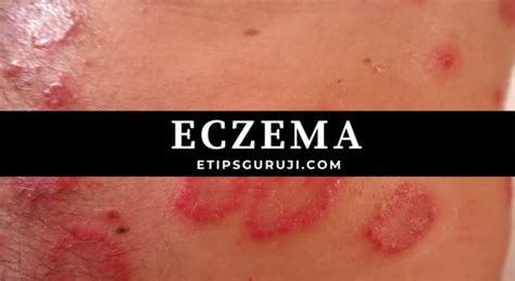 Eczema Disease Types Causes Symptoms Treatment And More