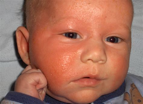 Infant Eczema Babyeczemajournal